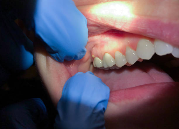 Best Lost Filling or Crown Replacement in Brookland, AR